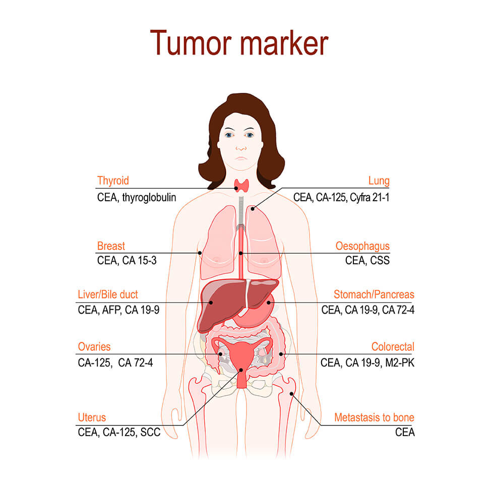 tumor-marker-akesis-life-integrative-oncology